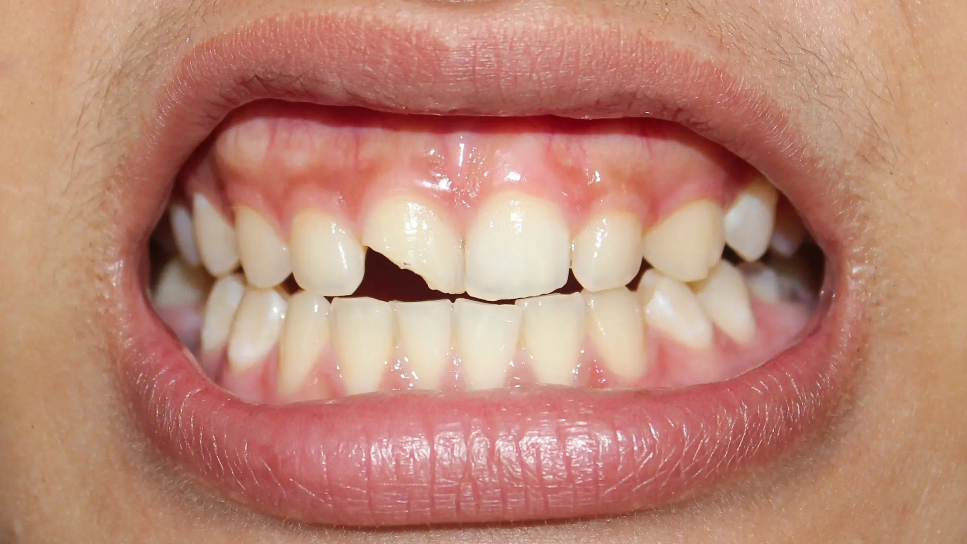 Dentist examining a chipped or cracked tooth during an urgent dental visit