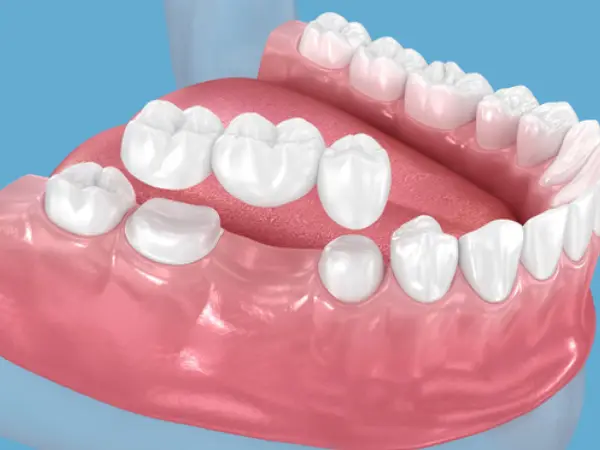 Crowns, Bridges, Implants and Restorative Options: Dental model showing crowns, bridges and restorative options for replacing or repairing damaged teeth.