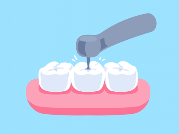 Fillings for Cavities and Tooth Damage: Illustration of a dentist removing tooth decay before placing a dental filling.
